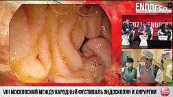 Ссылки на видеозаписи Endofest 2021